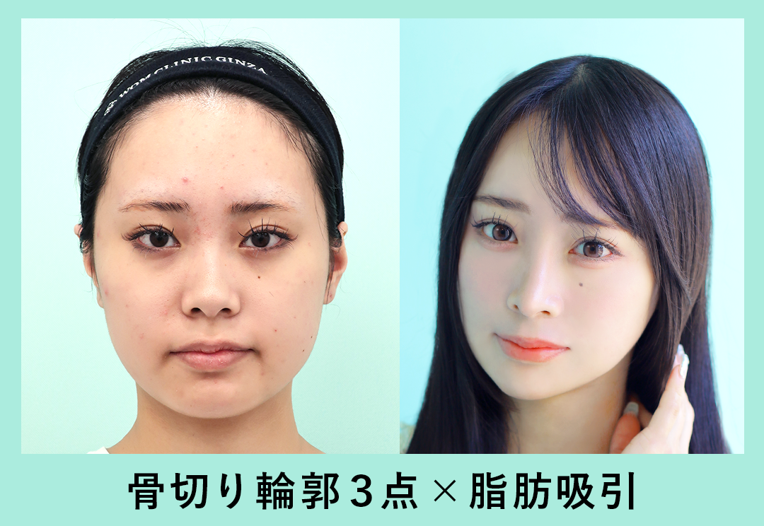 笑うと頬が盛り上がる整形疑惑の真相｜アンパンマン顔の原因と修正法