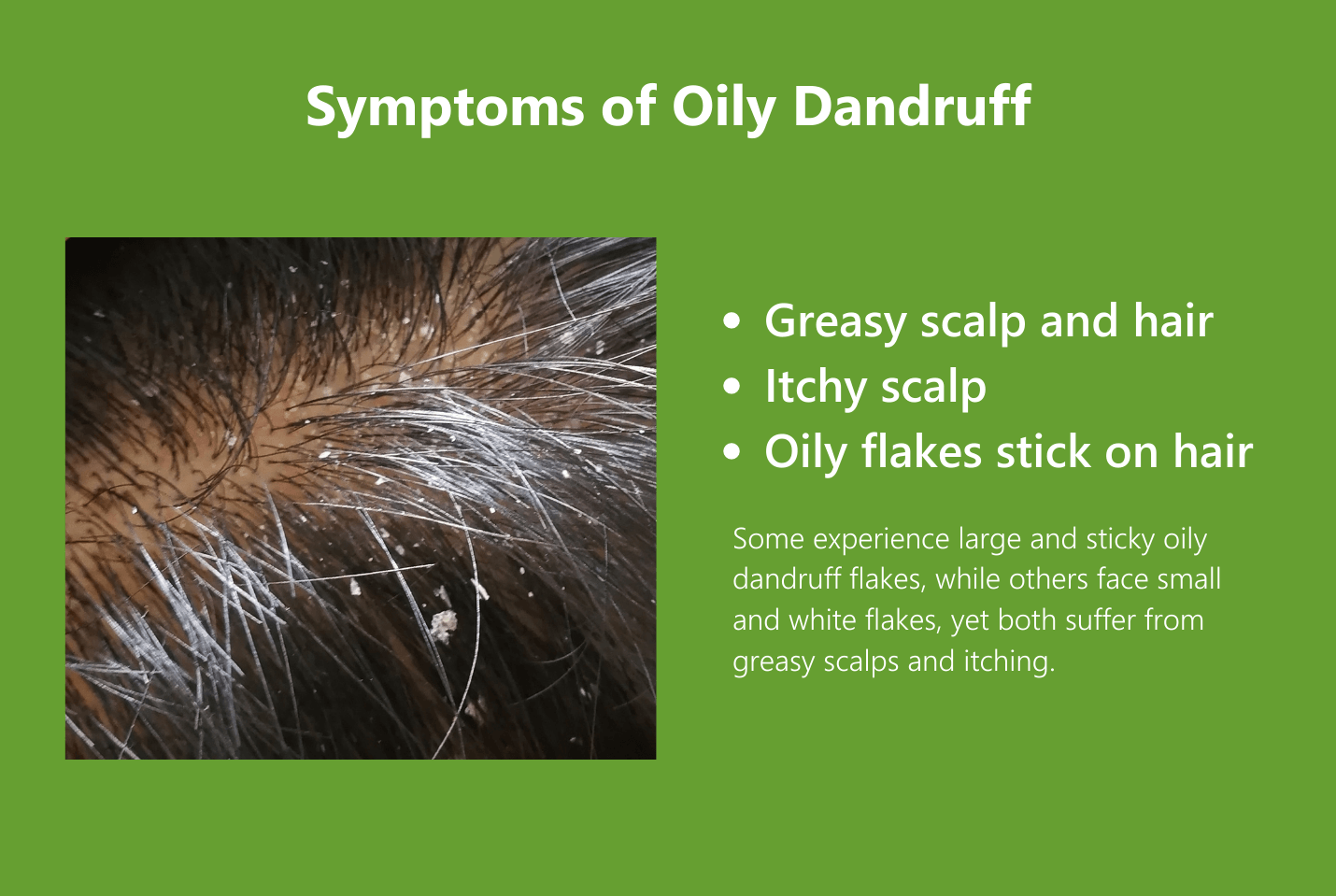 Dandruff from Oily Scalp