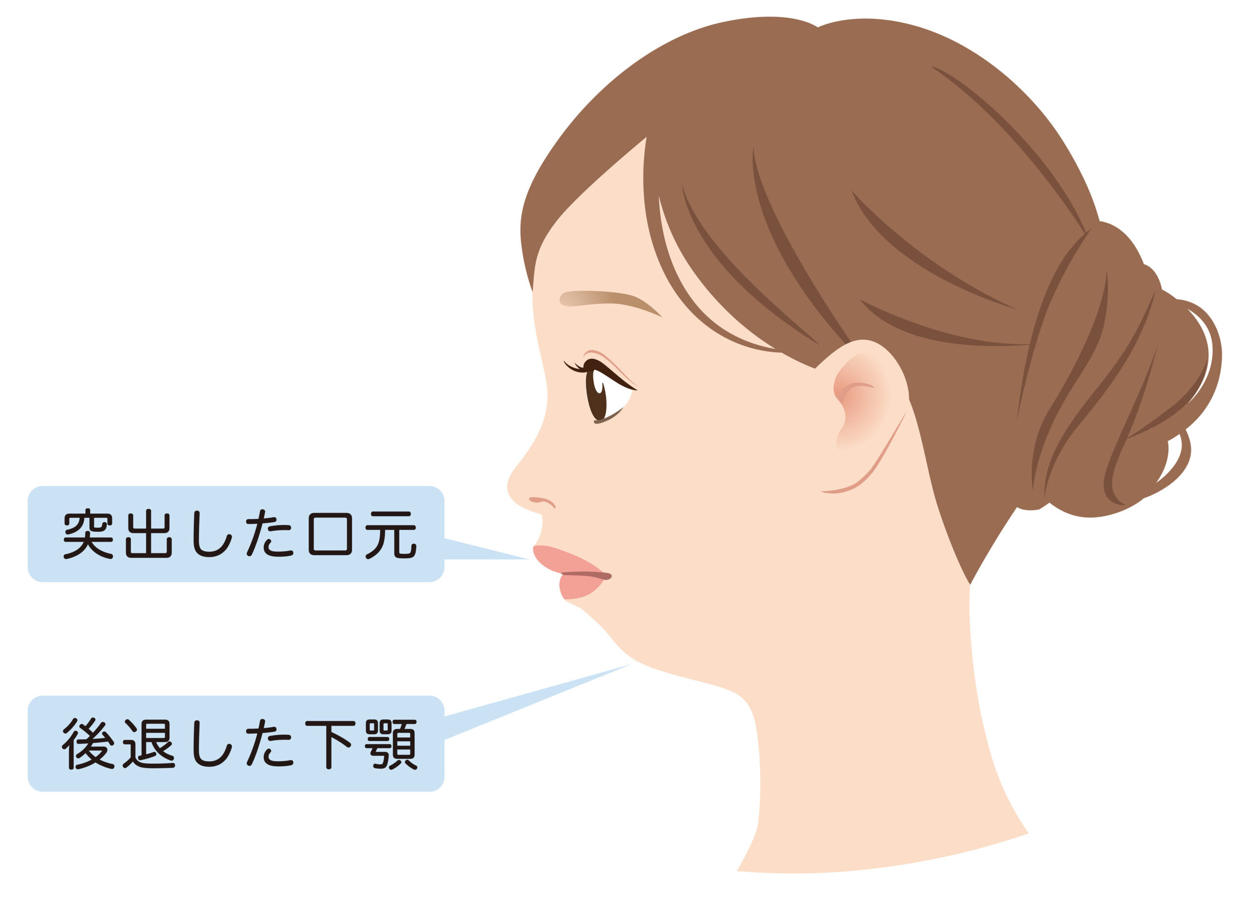横顔の悩みを解消！顎がない顔の原因と理想のＥライン作りの真実