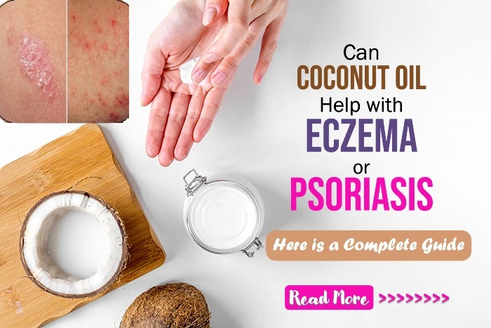 Can Coconut Oil Help Psoriasis