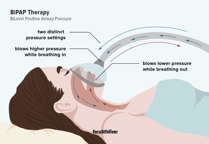 Can You Get Pip for Sleep Apnea