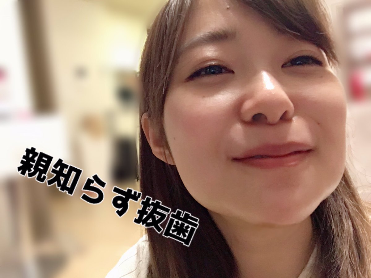 指原莉乃が明かした親知らず抜歯の全貌！輪郭の劇的変化と腫れ対策