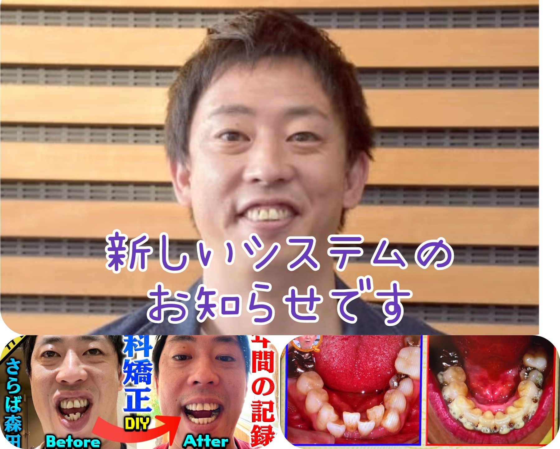 開咬を治した芸能人の劇的変化と治療法！滑舌や輪郭の真相を徹底解説
