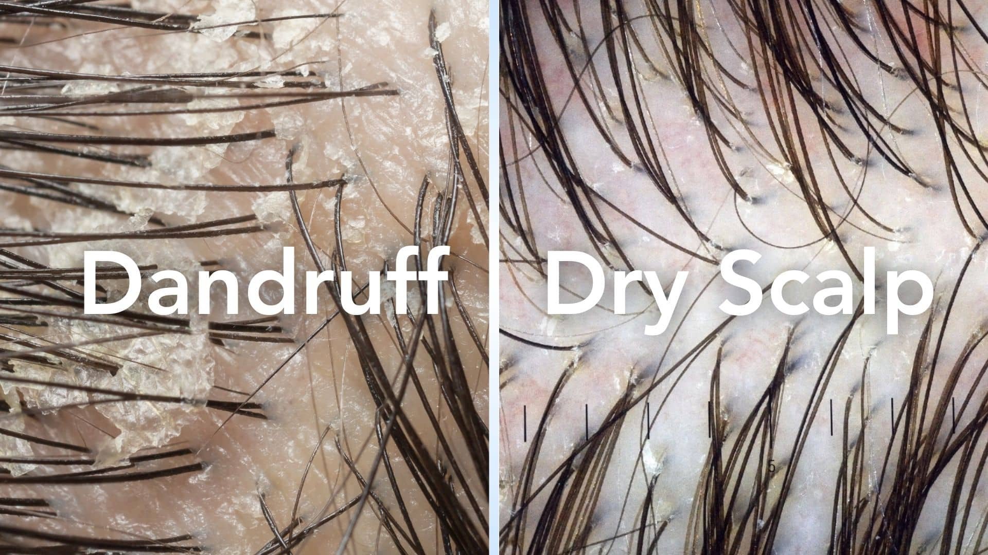What to Do If You Have Dry Scalp and Dandruff