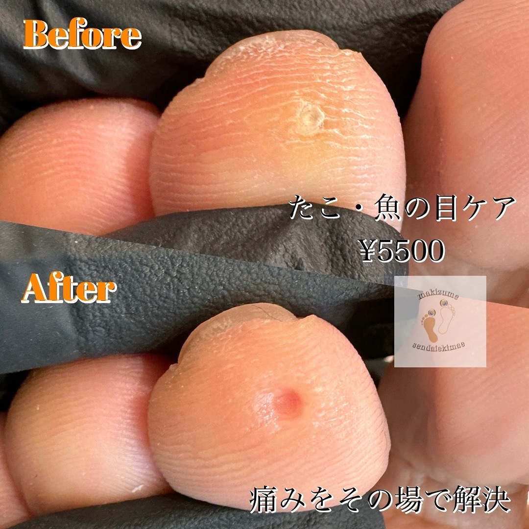 手の指の魚の目は実はイボ？原因と芯の見分け方や皮膚科の治療法