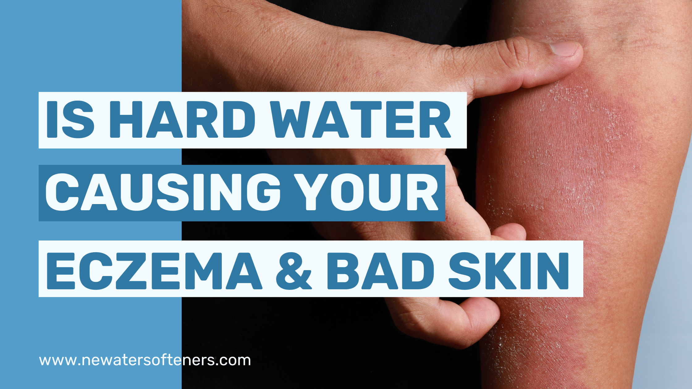 Does Hard Water Cause Eczema