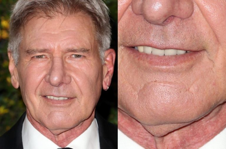 How Did Harrison Ford Get the Scar on His Chin