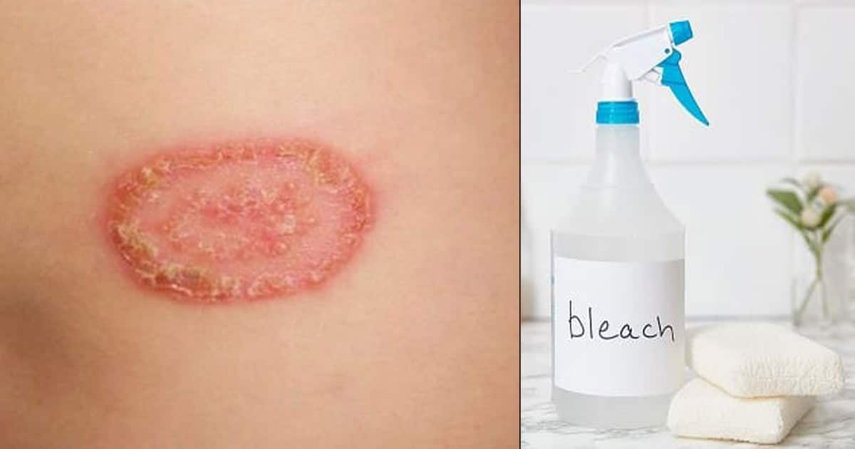 What Kills Ringworm on Surfaces