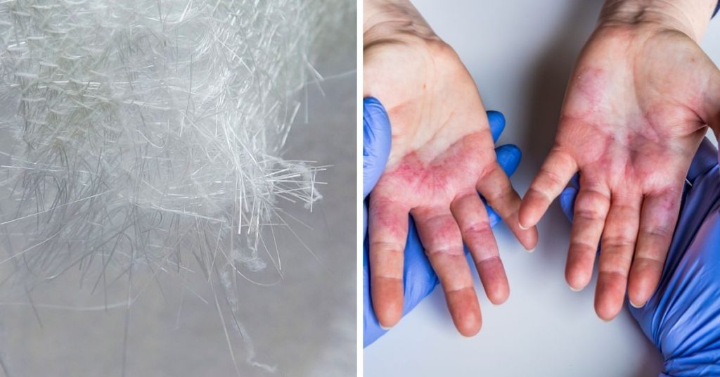 Skin Rash from Fiberglass