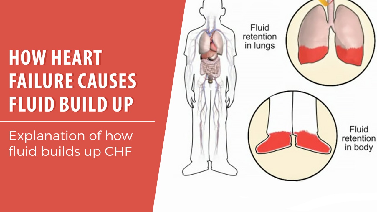 What Causes Fluid Buildup