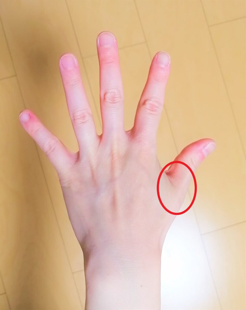 親指付け根の突き指は放置厳禁！骨折や靭帯断裂のサインと最新治療法