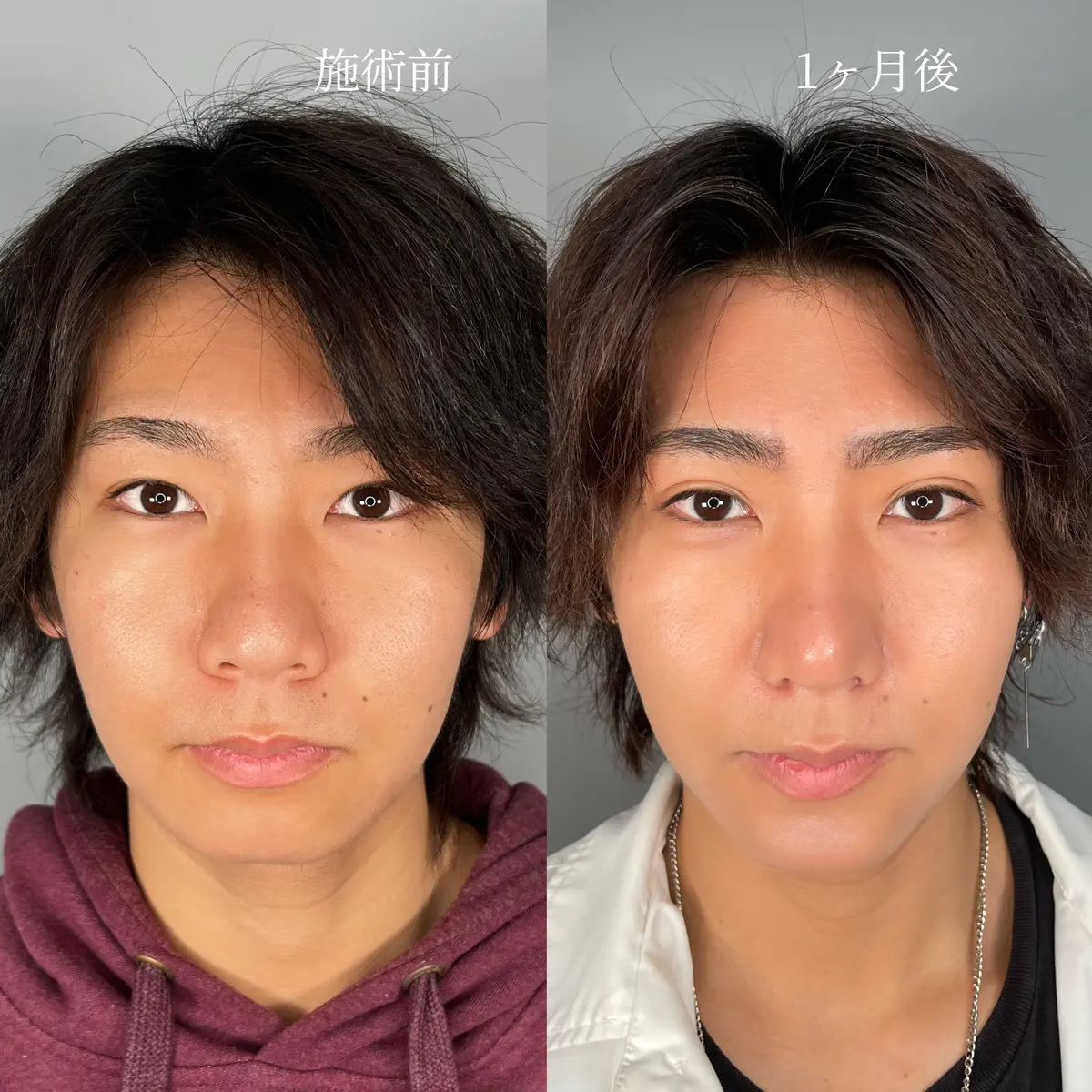 「男の二重は気持ち悪い」という風評の正体——メンズ美容急拡大の裏で起きている「不自然さ」の罠と最新意識調査【2026年ルポ】