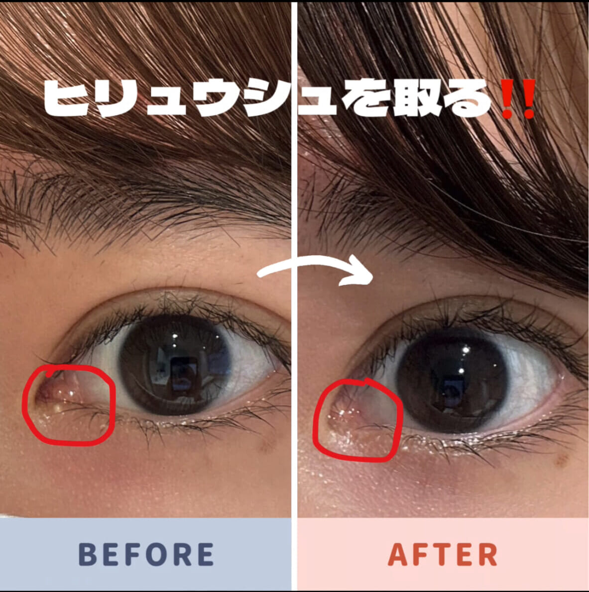 目の周りの白いポツポツ稗粒腫除去｜保険適用とレーザー費用【2026】