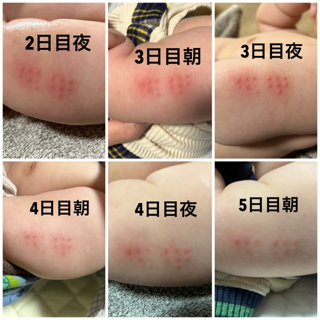 Bcg接種後1日後の写真で比較！翌日の赤みは正常かコッホ現象か