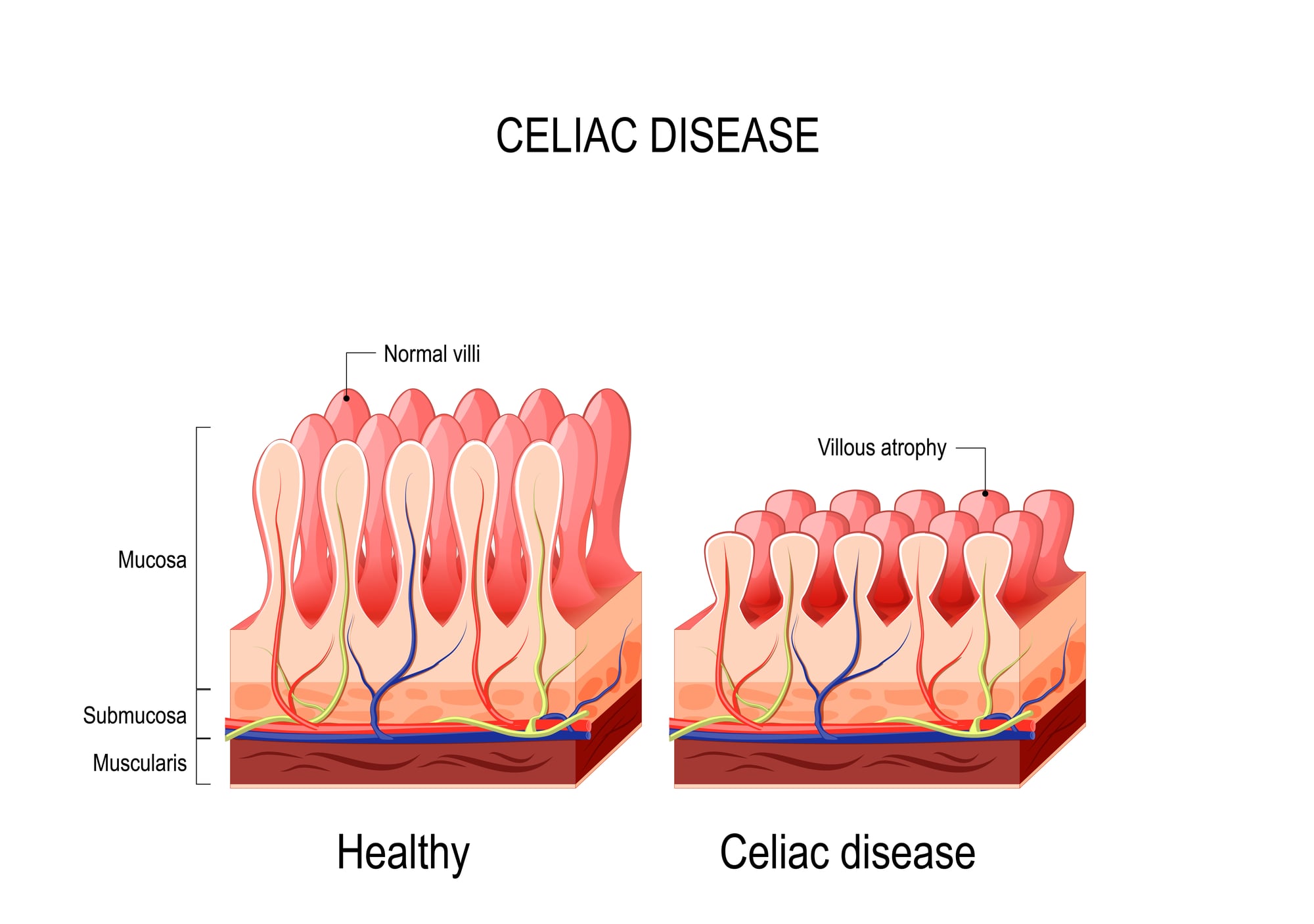 Do I Have Celiacs Disease