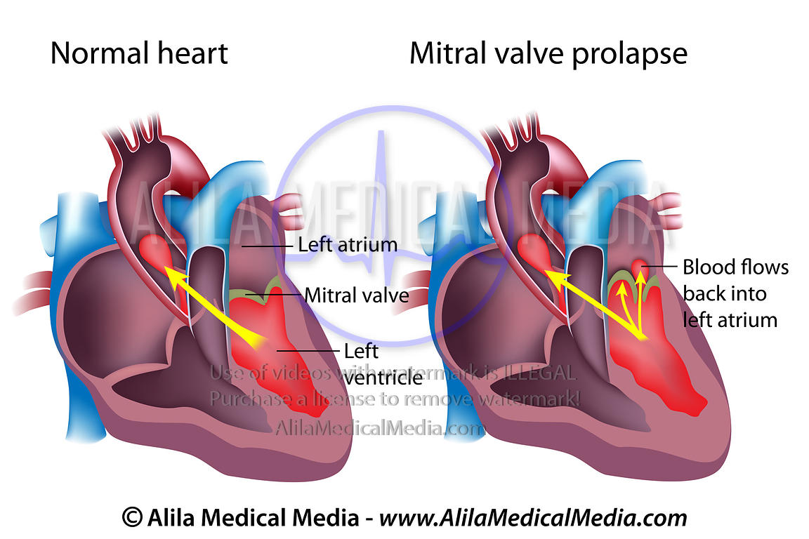 Mitral Valve Prolapse Medication