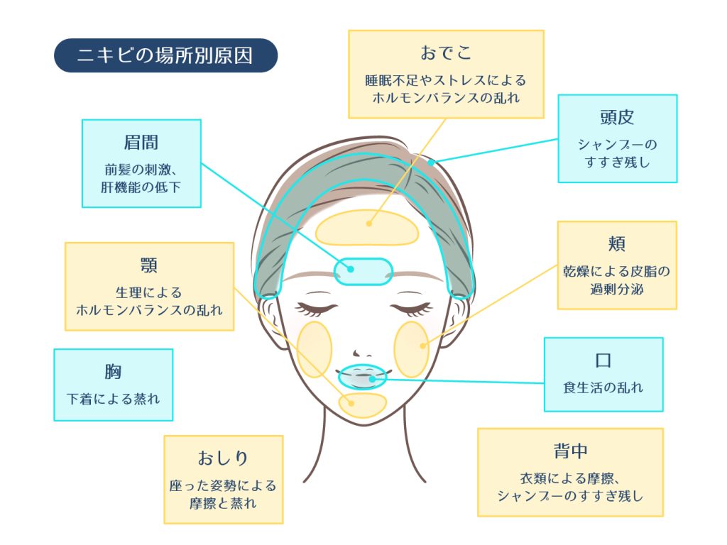 おでこニキビを即効で治す！一晩ケアの真相と皮膚科推奨の最短改善術