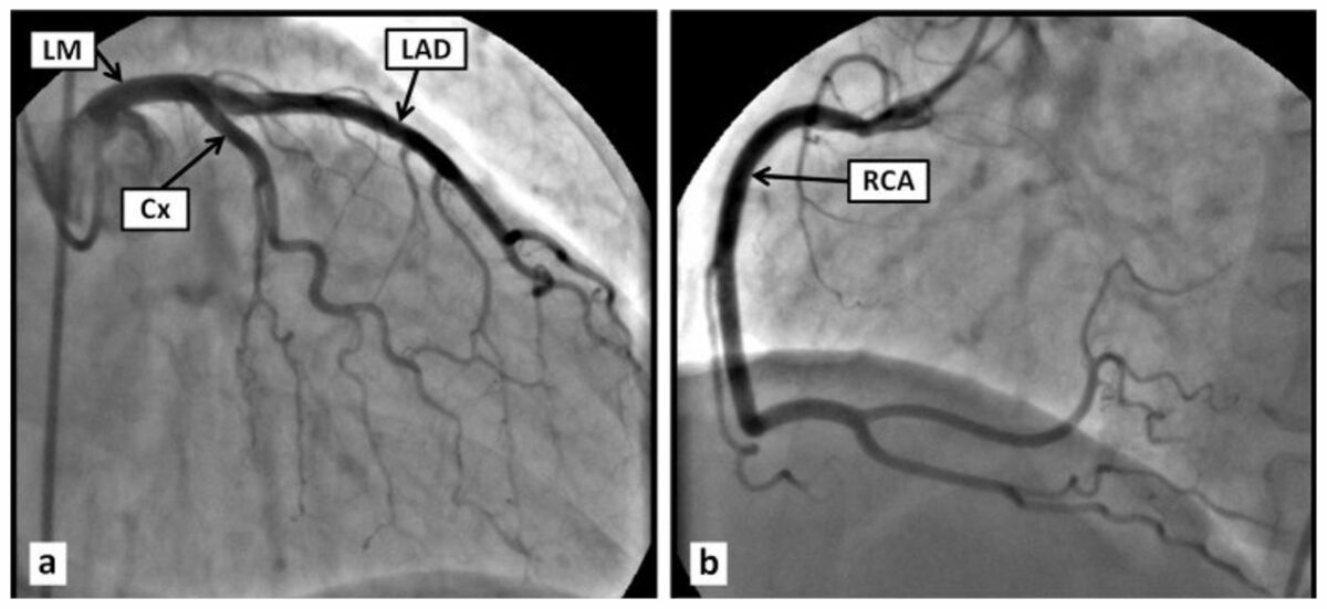 Coronary Angiogram and Angiography