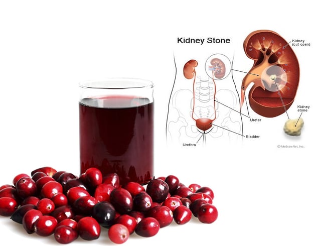 Is Cranberry Juice Bad for Kidney Stones