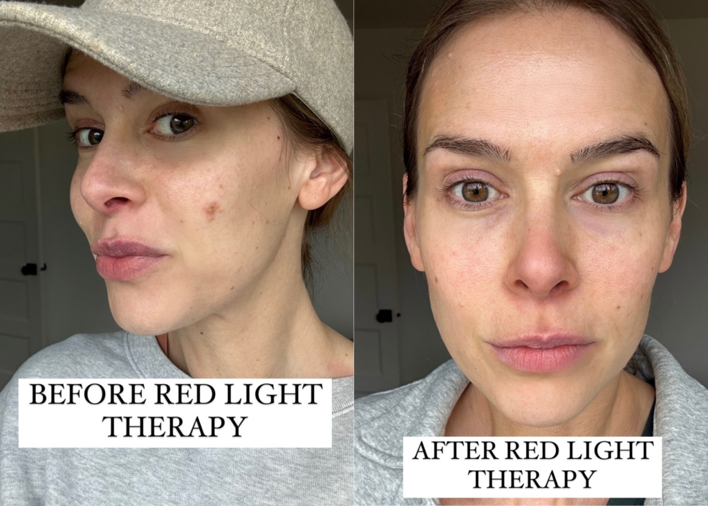 Red Light Therapy Before and After Pictures
