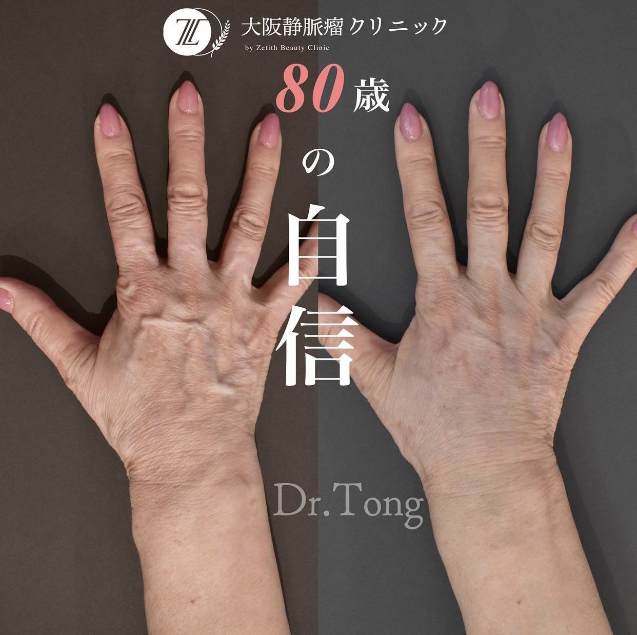 手の血管が浮き出る原因は病気か？2026年最新の老け手改善法を解説
