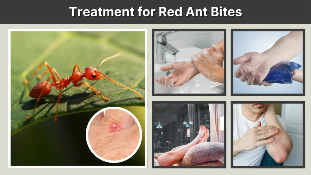 Ant Bites Treatment