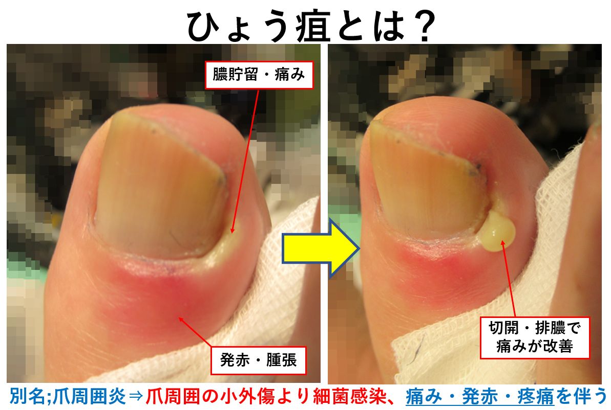 爪のズキズキ痛は爪囲炎？ささくれ放置の化膿リスクと正しい治し方