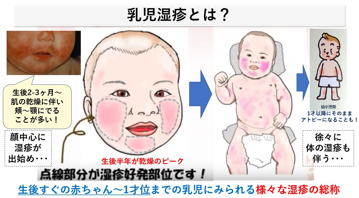 赤ちゃんの顔の乳児湿疹はなぜ治らない？原因と正しいケア＆受診目安
