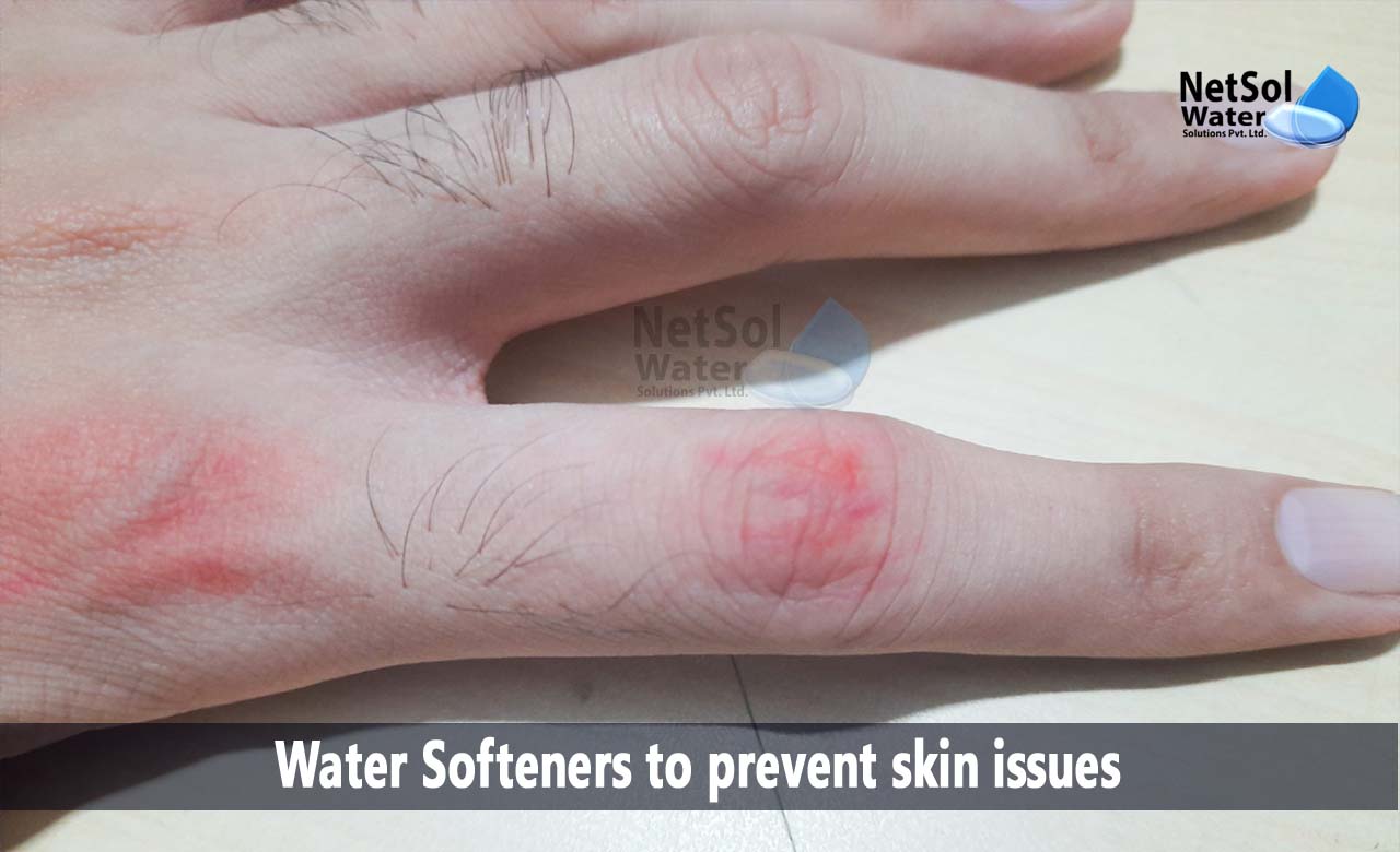 Does Water Softener Help Eczema