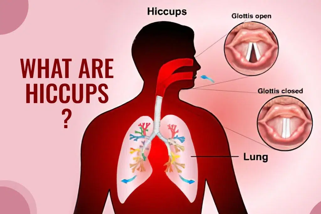 Constantly Getting Hiccups