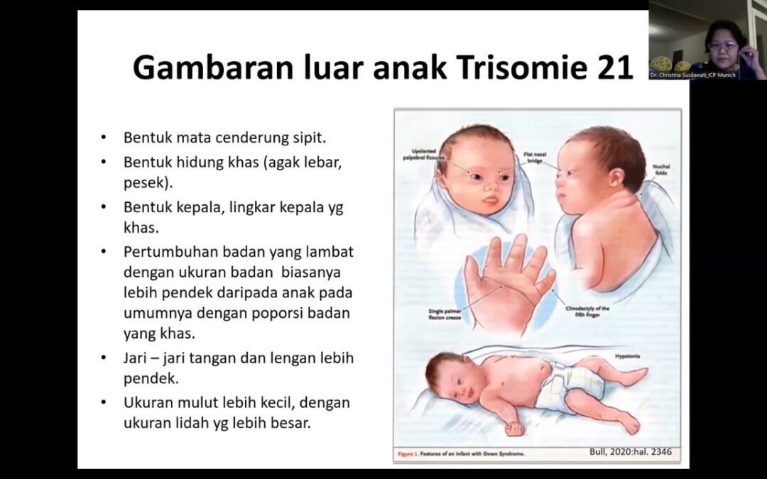 Ciri Khas Bayi Down Sindrom
