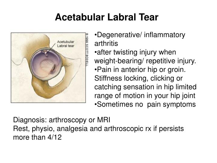 Icd 10 Code for Left Hip Labral Tear