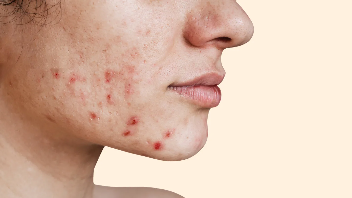 Can Yogurt Cause Breakouts
