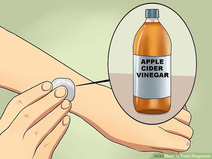 Will Apple Cider Vinegar Kill Ringworm