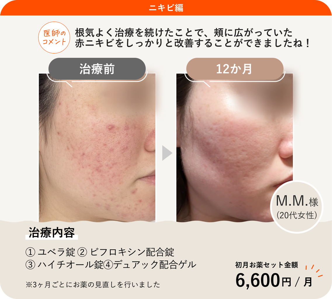 赤ニキビを即効で治す方法！一晩で炎症を鎮静する緊急ケアと最新処方