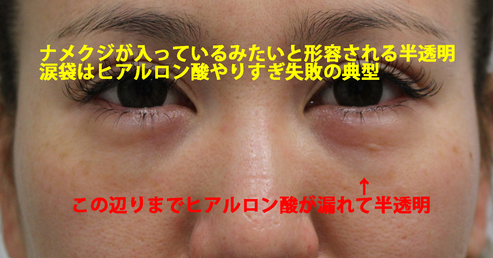 涙袋ヒアルロン酸失敗の真相｜ナメクジ化の原因と後悔しない修正法