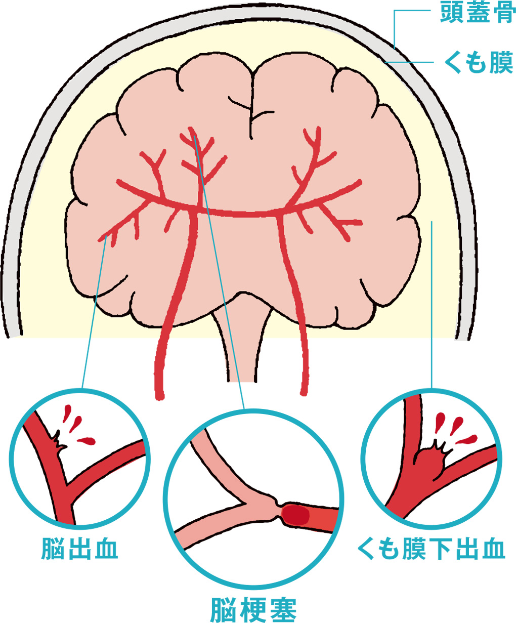 脳の血管が切れるとどうなる？前兆と助かる確率・最新治療を徹底解説