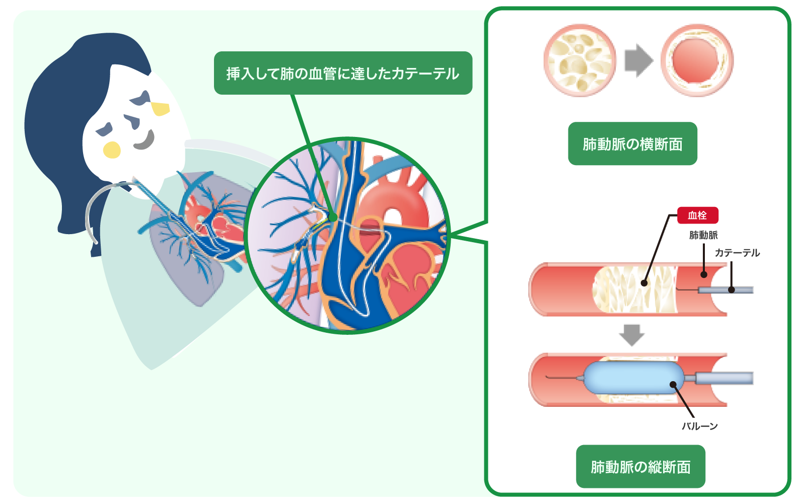 息切れは難病のサイン？慢性血栓塞栓性肺高血圧症の最新治療と予後