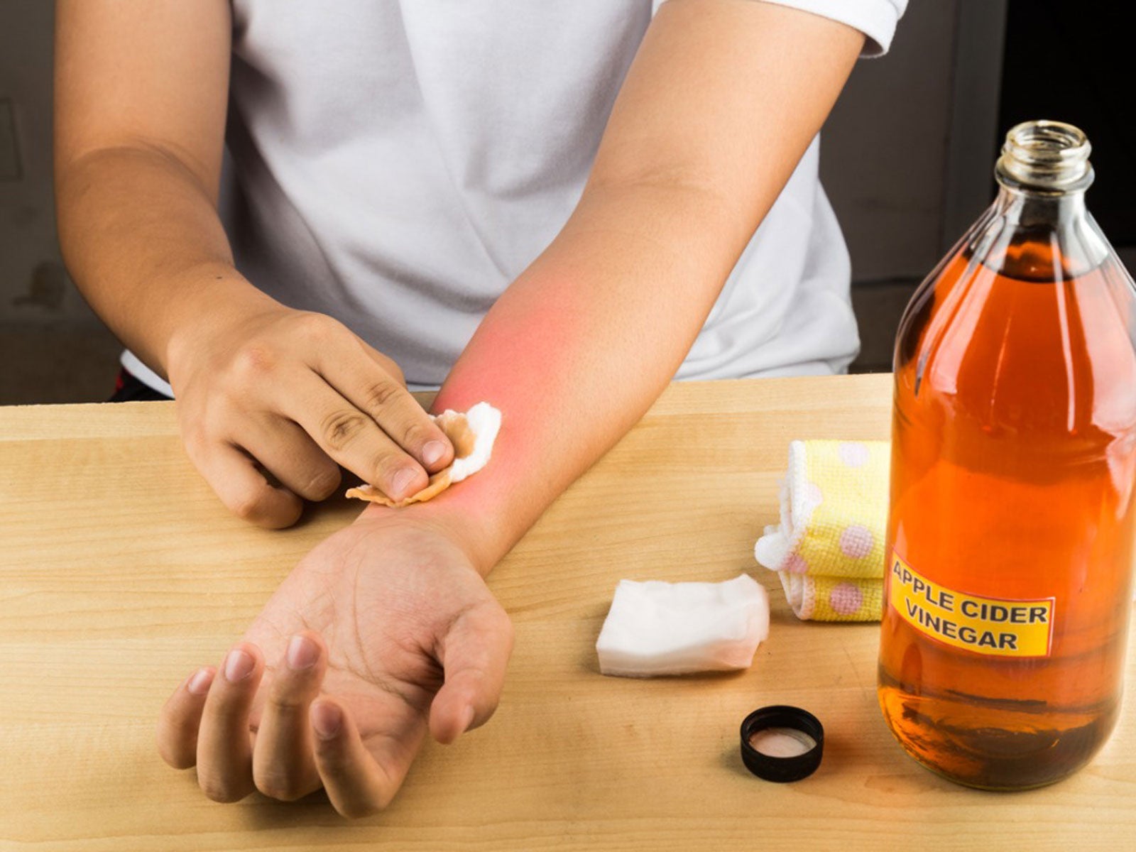 How to Neutralize Jalapeno Burn on Skin