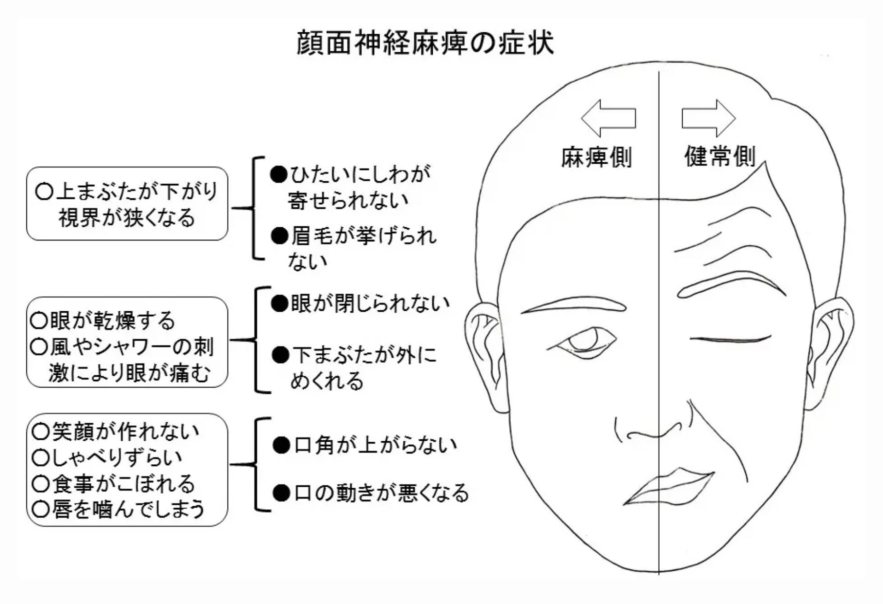 ラムゼイ・ハント症候群の真実｜初期症状と完治率・ベル麻痺との違い