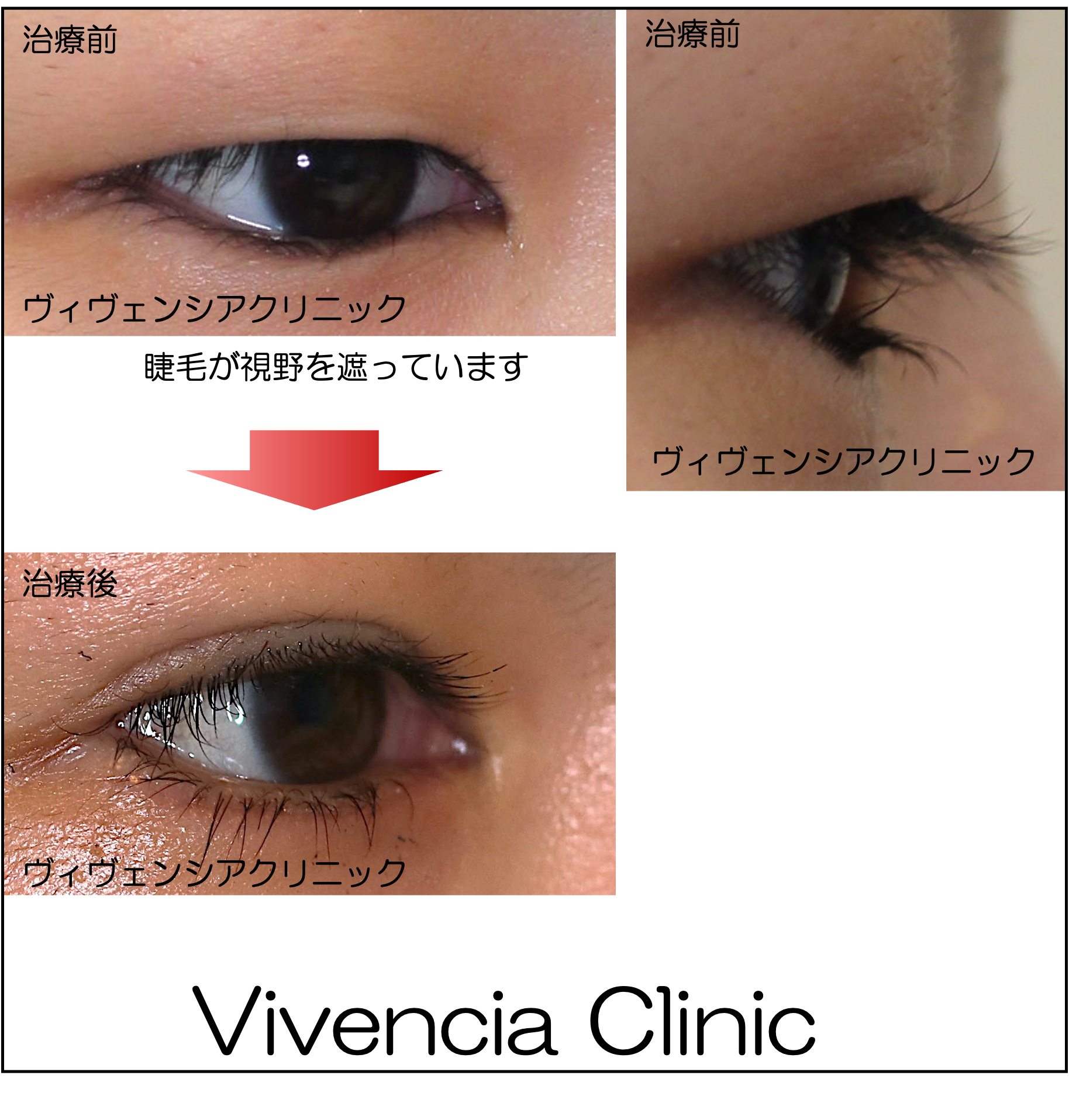 重い一重まぶたの根本原因と解消法｜アイプチの限界から最新改善策まで