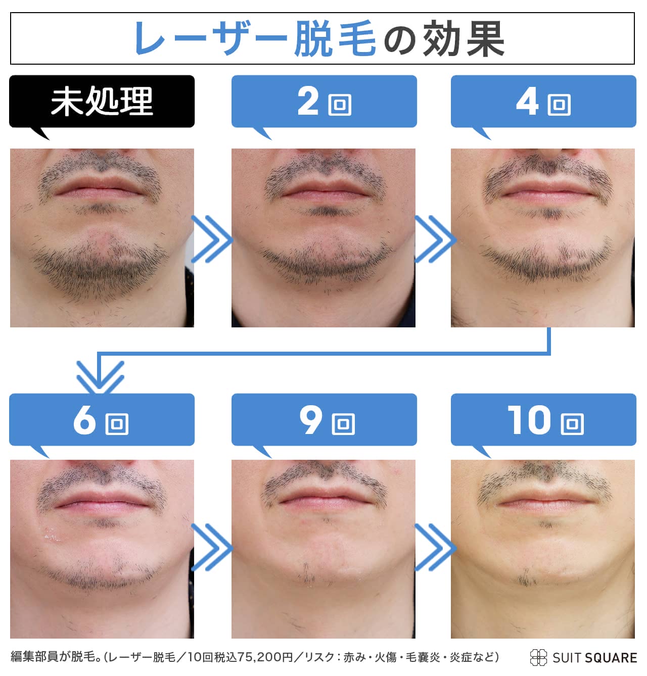 脱毛は何回目から効果が出る？「抜けない」真相と回数目安のリアル