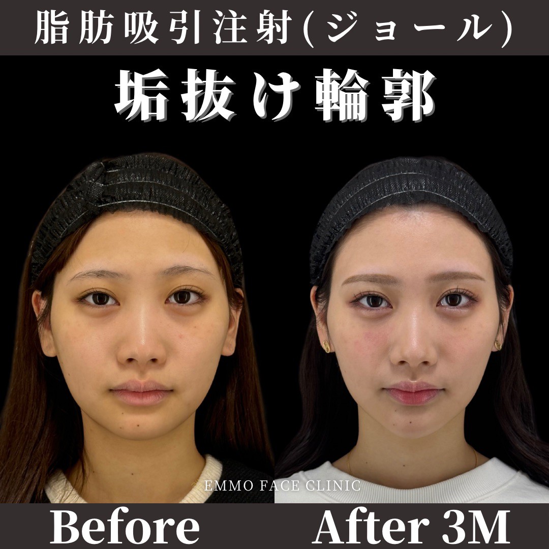 ほっぺの肉を落とす決定版！食事制限で減らない原因と最新即効ケア