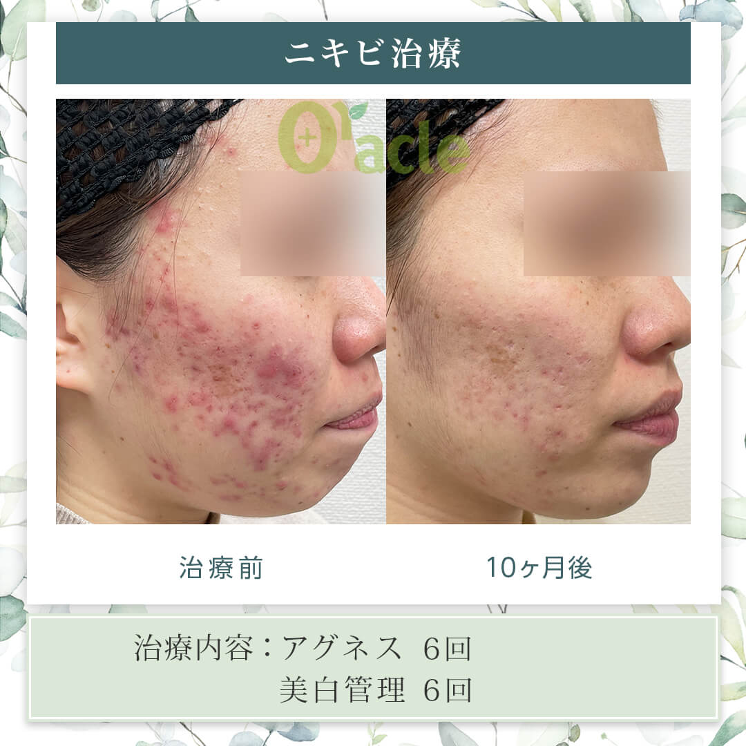 ニキビ跡美容液の選び方と効果の真相【2026年最新】赤み・凸凹を徹底比較