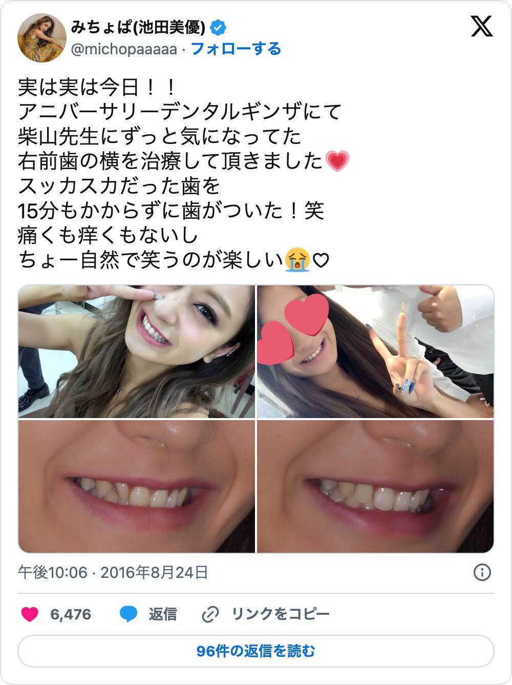 白すぎる芸能人の歯の秘密！セラミック矯正の失敗しない選び方と費用