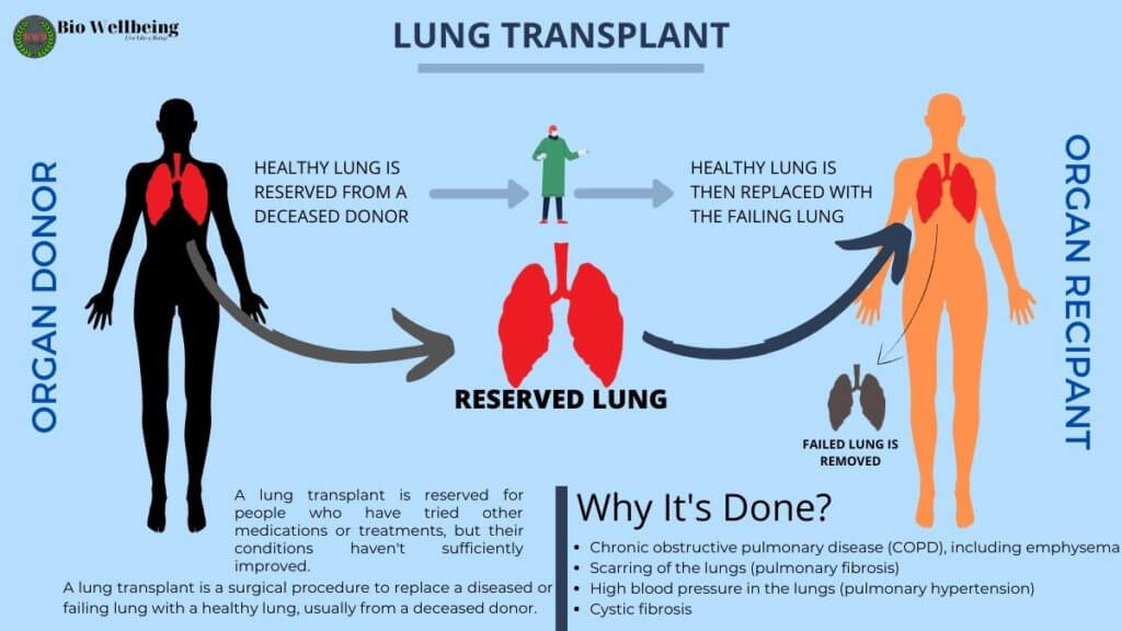 Will a Lung Transplant Cure Cystic Fibrosis