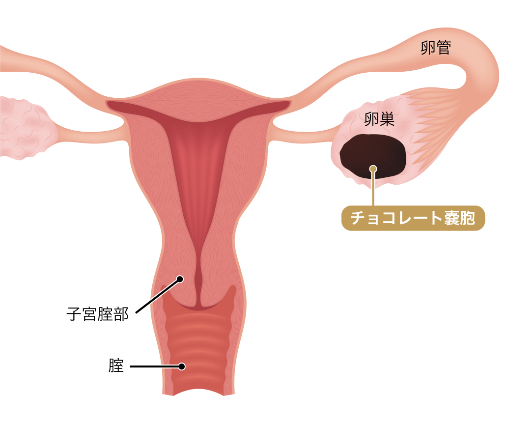 子宮内膜症チョコレート嚢胞の放置は危険？癌化率と手術基準の真相