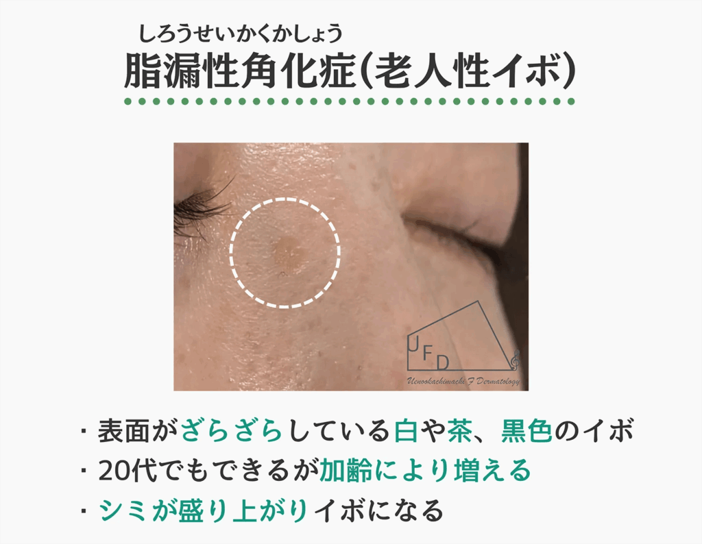 顔の白いイボの正体とは？目の周りのブツブツ原因と安全な除去法