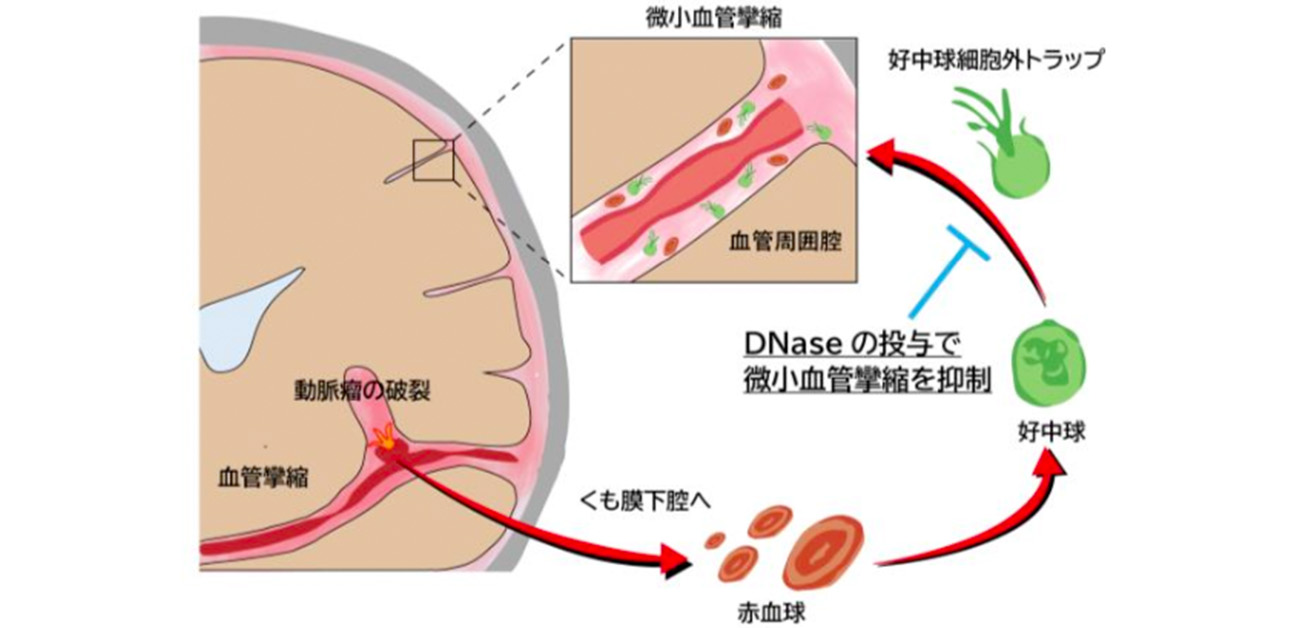 くも膜下出血後の第二の危機「脳血管攣縮」予兆と命を守る治療法
