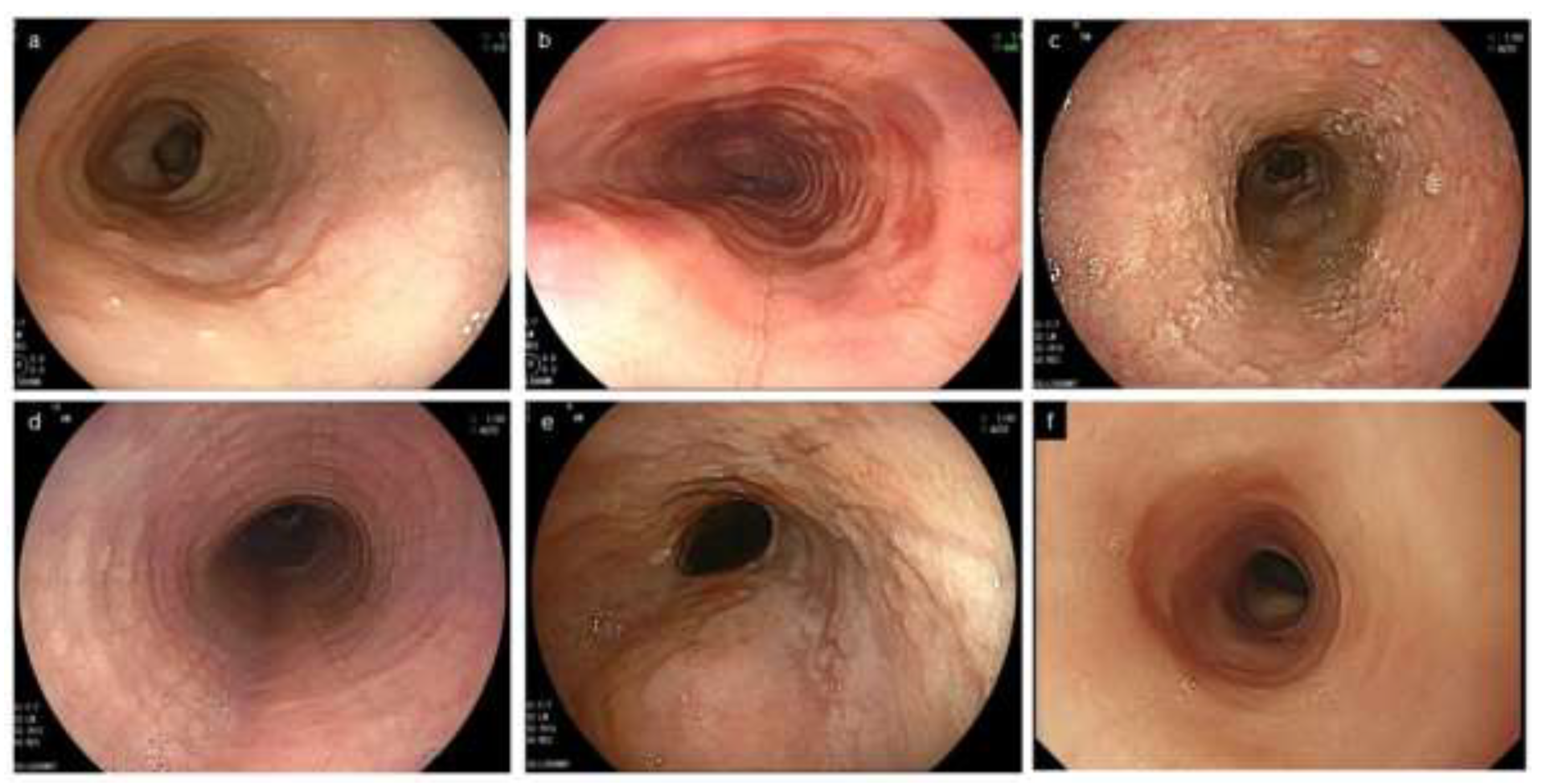 How Is Esophagitis Diagnosed and Treated? What to Know After Kim Kardashian’s Disclosure